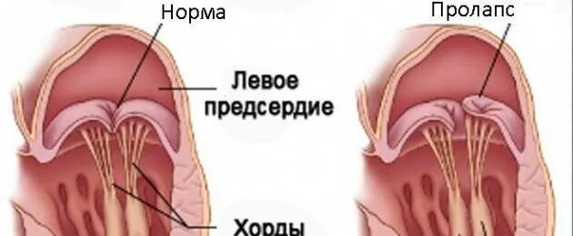 Пмк 1 степени что это такое. Пролапс хорды митрального клапана. пролапс митрального клапана симптомы у мужчин. пролапс передней створки митрального клапана 1 степени аппарат. пролапс трикуспидального клапана 1 степени.