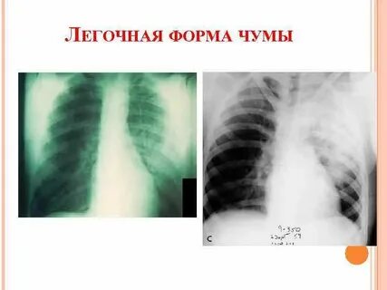 Чума клинические
