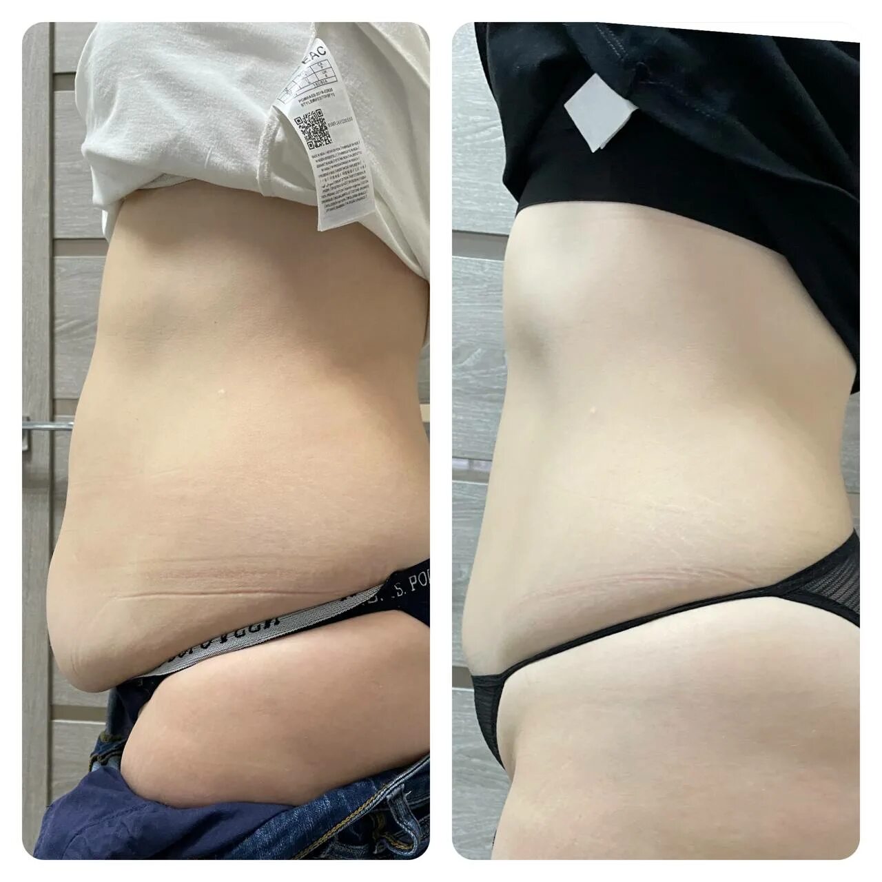 Криолиполиз галифе до и после. Cocoon аппарат криолиполиз. Процедура криолиполиза. Криолиполиз аппарат cryo. Криолиполиз методика проведения.