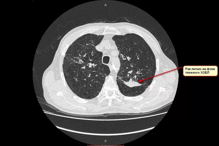 ХОБЛ кт кт. Бронхиальная карцинома на кт. ХОБЛ на кт.