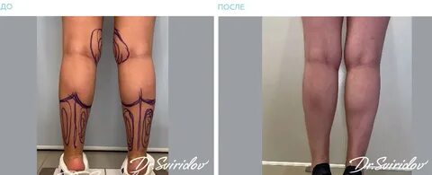 Липосакция ног до и после