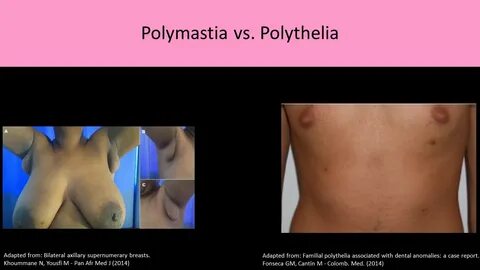 Polymastia Girl Naked.