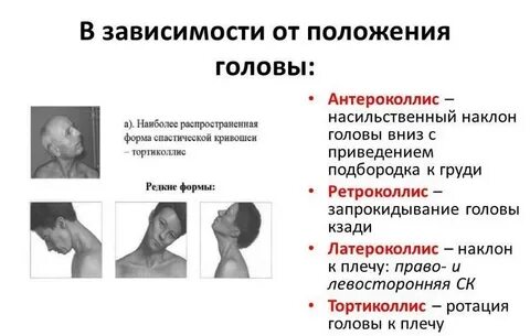 Кривошея у взрослых отзывы