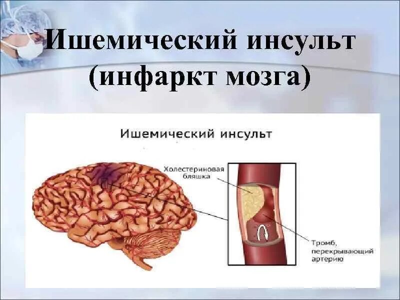 Инфаркт мозга причины. Ишемический инсульт (инфаркт мозга). Инфаркт головного мозга и инсульт. Исход ишемического инфаркта головного мозга.