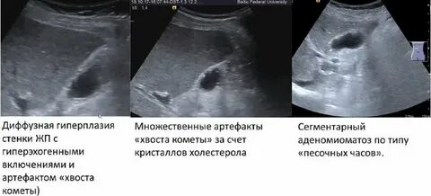 Аденомиоматоз желчного пузыря