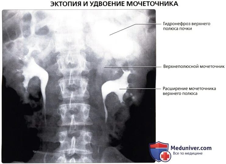 Удвоение мочеточника. Удвоение почки рентген. Удвоение мочеточника рентген. Урография удвоение мочеточника. Неполное удвоение мочеточника кт.