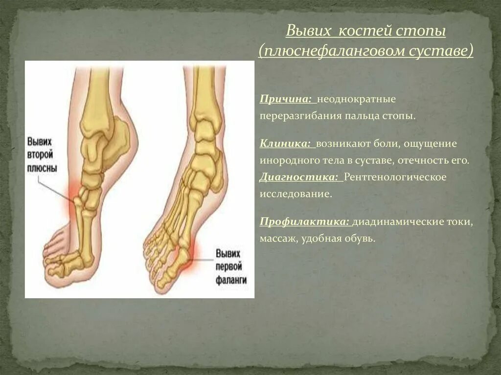 Почему болит кость пальца. Суставы стопы. Сочленения стопы.