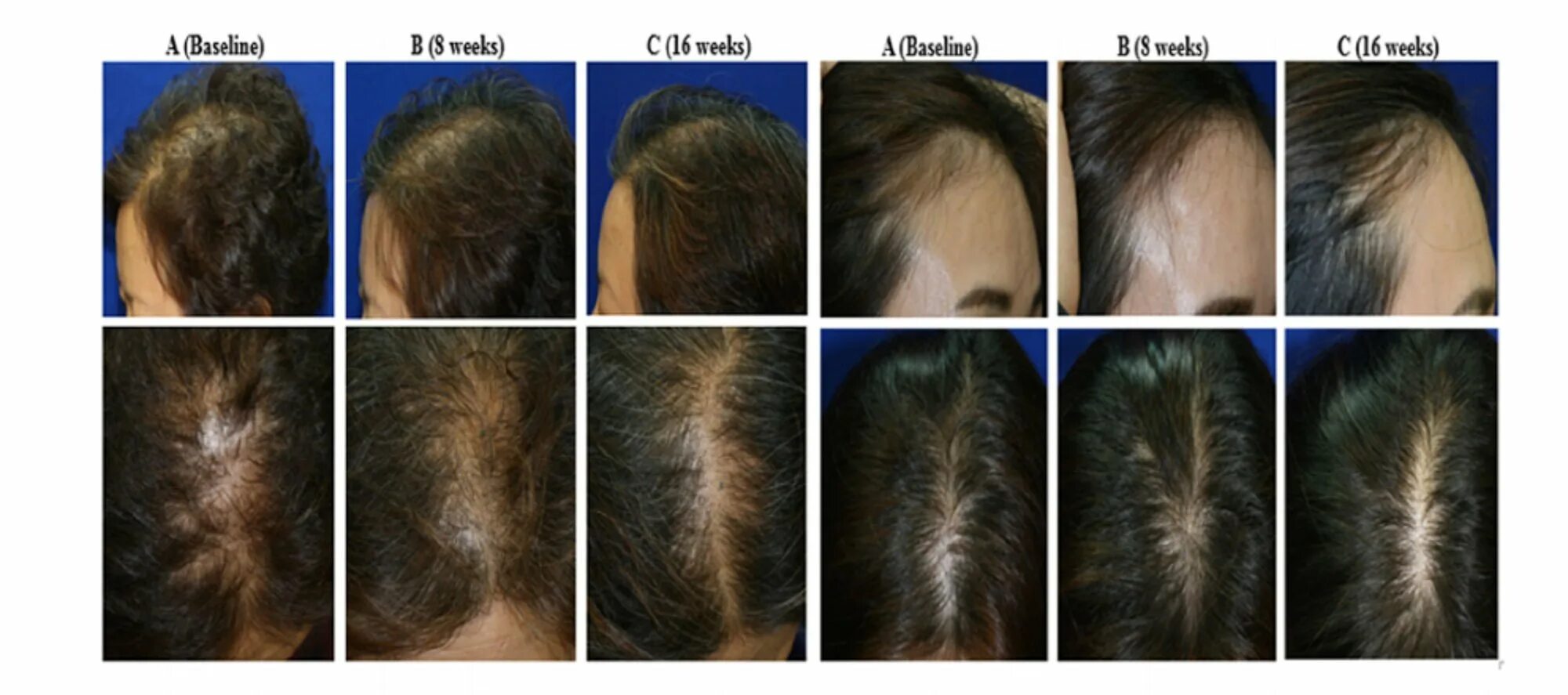Химиотерапия рост волос. Отрастание волос по месяцам. Рост волос по месяцам. Для роста волос. Рост волос на голове.