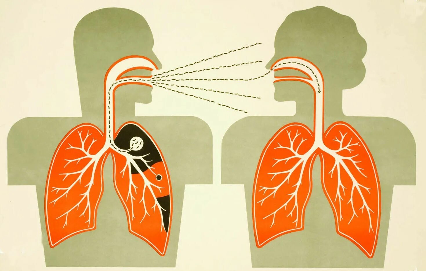 Туберкулез tuberculosis. Воздушно капельный путь передачи туберкулеза. Воздушно капельный путь заражения туберкулезом. Туберкулёз лёгких пути передачи. Пути передачи туберкулеза картинки.