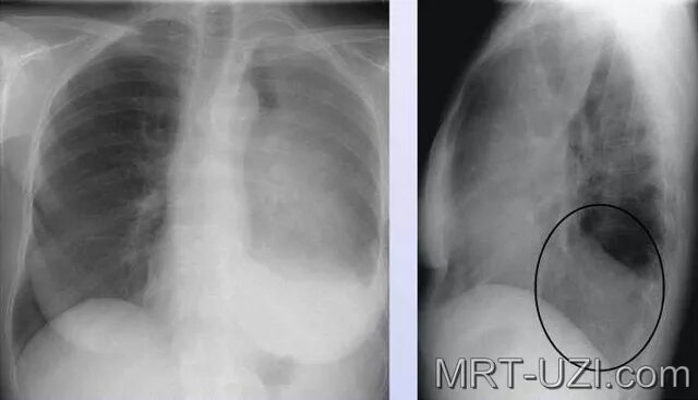 флюорография видит рак