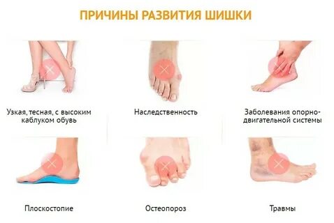 Лечение шишек стопы