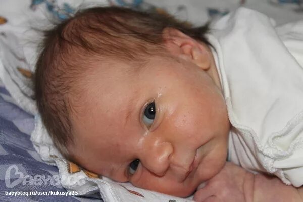 Желтушность склер новорожденного. Глаза новорожденного при желтухе. Склеры при желтушке у новорожденных.