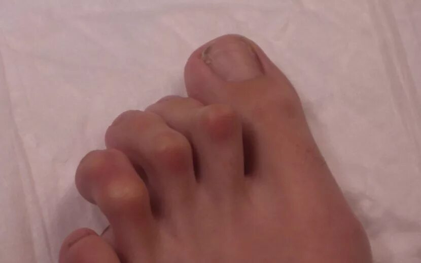 Молоткообразная деформация пальцев стопы рентген. Деформация 2 пальца стопы. Деформация 2 пальца стопы. Молоткообразная деформация пальцев стопы корректор. Вальгусная деформация косточки.