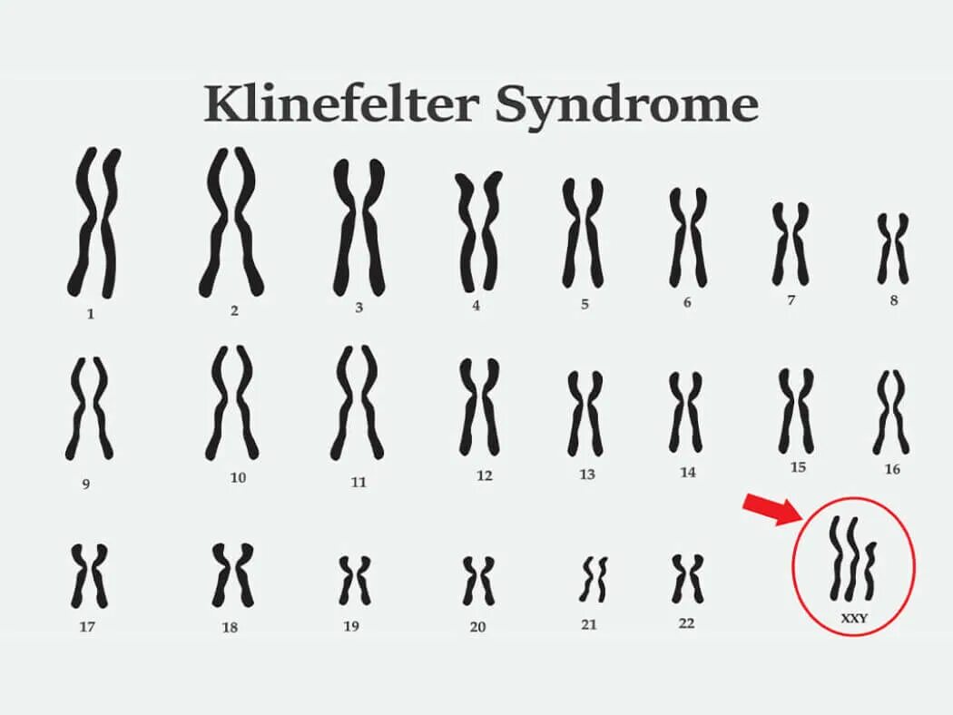 Xxy хромосома. Синдром Клайнфельтера кариотип. Синдром Клайнфельтера 47 xxy. Кариотип больного с синдромом Клайнфельтера. Синдром Клайнфельтера клинические проявления.