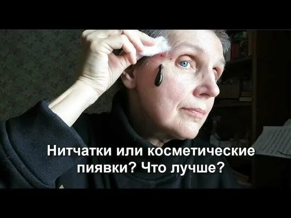 подтяжки лица пиявками. подтяжки лица пиявками. гирудотерапия в косметологии. подтяжка овала лица пиявками. постановка пиявок на лицо.