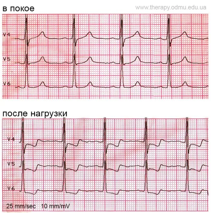 Ишемия боковой стенки. ЭКГ при стенокардии покоя. Стабильная стенокардия напряжения ЭКГ. Стабильная стенокардия напряжения 2 ФК ЭКГ. ЭКГ при ИБС стенокардия напряжения 2 ФК.