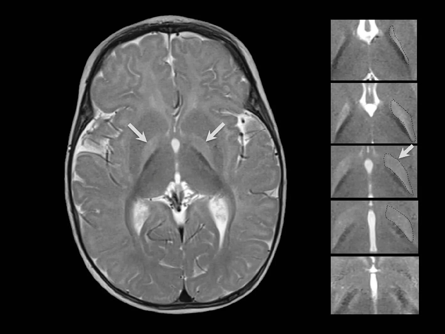 Энцефалопатия головного мозга последствия. Билирубиновая энцефалопатия. MRI t1 t2. Энцефалопатии Вернике СКТ. Ядерная желтуха (билирубиновая энцефалопатия) у новорожденных.