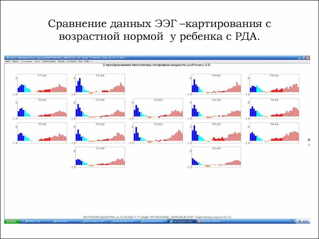 Картирование данных. Ээг картирование. ээг топоселективное картирование.. ээг возрастная норма. дисперсионное картирование сердца нормы.
