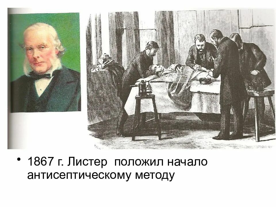 Антисептика листера 19 век. Листер антисептика. Листеровская антисептика. Повязки листера. Повязки листера.