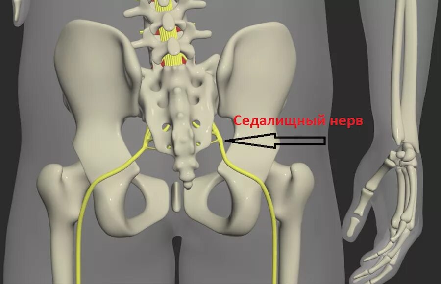 Как лечить защемление в пояснице. Защемление седалищного нерва в пояснице. Седалищный нерв грыжа позвоночника. Пояснично-крестцовый отдел защемление седалищного нерва. Защемление поясничного нерва.