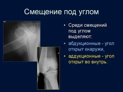 Угол перелома