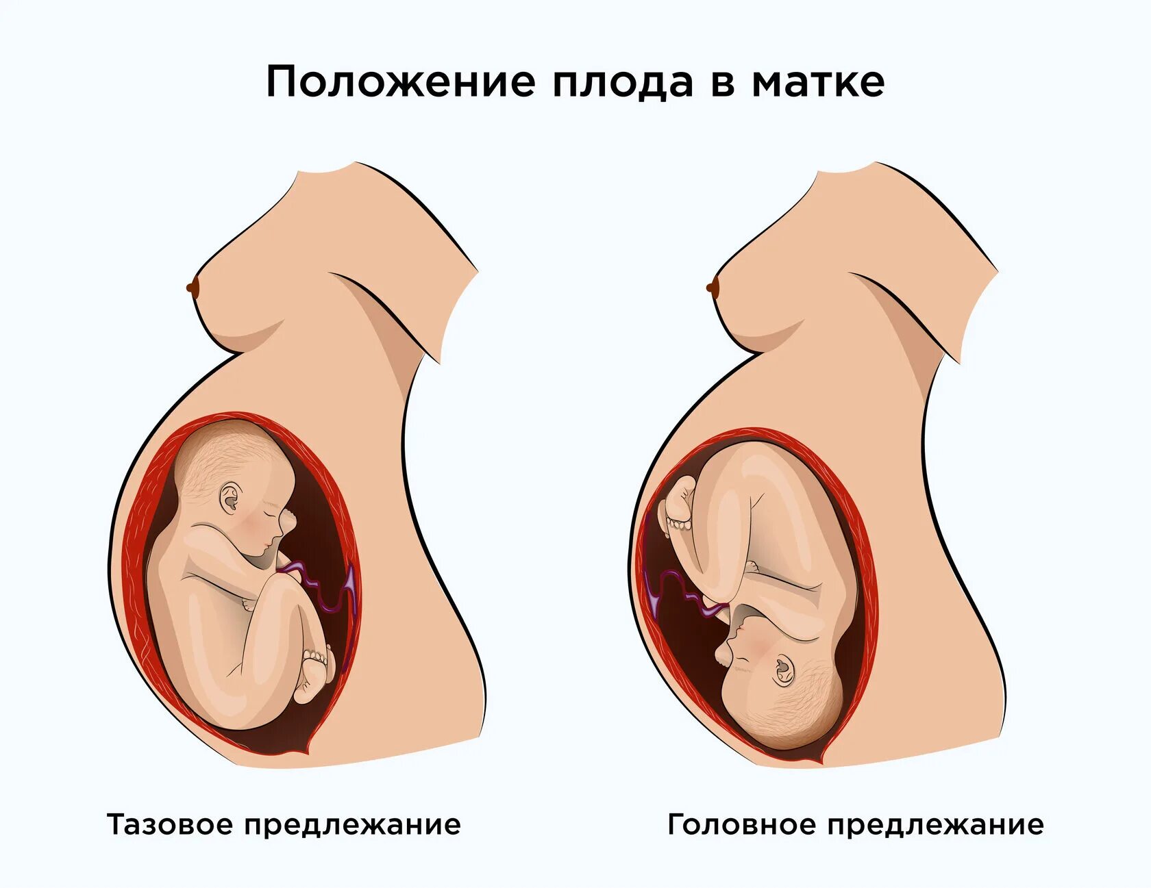 Положение ребенка в животе. Положение ребенка в животе матери. 36 недель тазовое