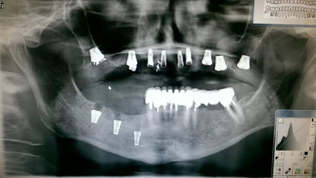 Рекомендации по установке имплантов. Для всех. Часть V. - IMPLANT-IN.COM - дента