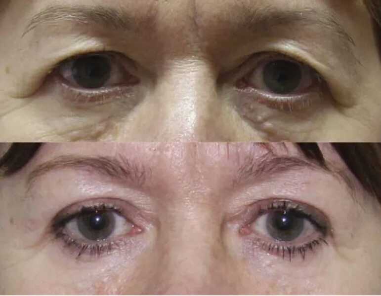 плазмолифтинг блефаропластика безоперационная. красивая кожа вокруг глаз.