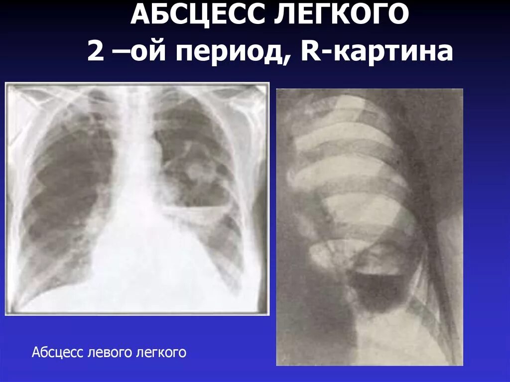 После абсцесса легкого. Дренирующийся абсцесс легкого. Абсцесс легкого рентгенограмма. Рентгенологическая картина абсцесса легкого. Стадии абсцесса легкого.