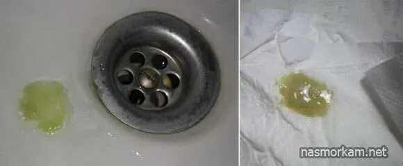 Мокрота при кашле. Отхаркивается серо зеленая слизь. отхаркивается мокрота зеленоватая. отхаркивается зеленая мокрота с кашлем. при кашле отхаркивается мокрота.