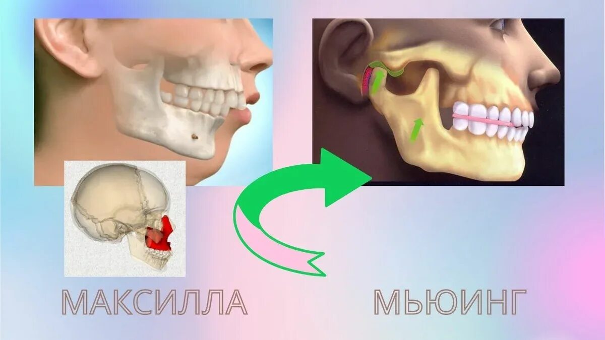 Максилла Мьюинг. Максилла кость красоты. Что такое Мьюинг для лица.