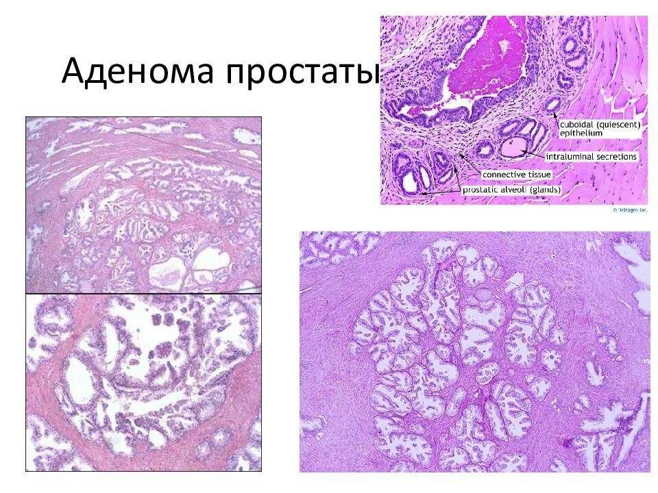 Железистая гиперплазия предстательной железы. Гиперплазия предстательной железы патанатомия. Гиперплазия предстательной железы гистология. Гиперплазия предстательной железы патологическая анатомия.