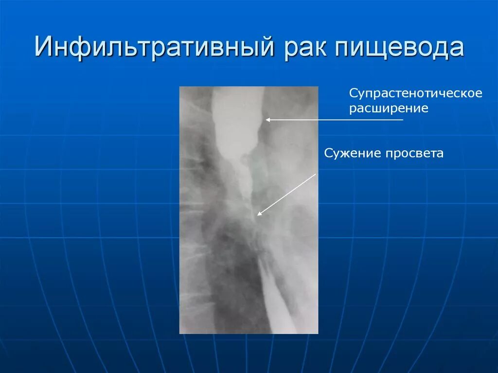 Диффузно инфильтративная. Супрастенотическое расширение пищевода рентген. Опухоль пищевода рентген. Супрастенотическое расширение желудка.