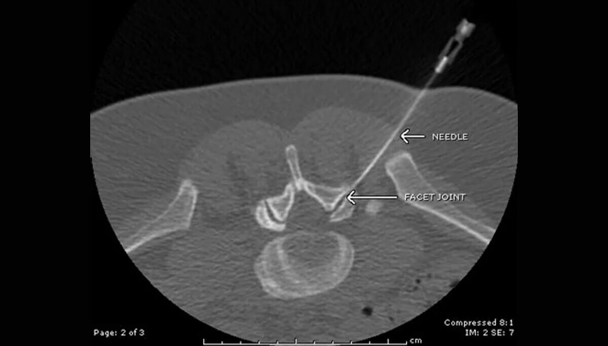 Фасеточная блокада. Это блокада нерва под УЗИ контролем. Блокада фасеточных суставов под УЗИ контролем. Блокада фасеточных суставов поясничного отдела позвоночника. Блокада под контролем кт.