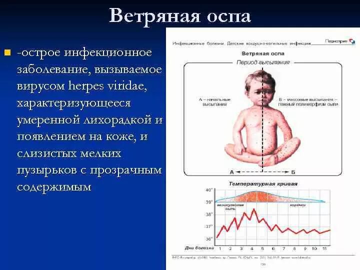 Лихорадка при ветряной оспе. Диагностика при ветряной оспе. Сестринский процесс ветряной оспы.