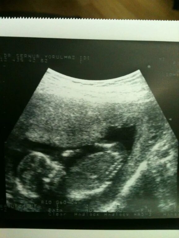15 акушерских недель. Снимок УЗИ 14 недель беременности. Эмбрион на 14 неделе беременности УЗИ. УЗИ 13 акушерских недель.