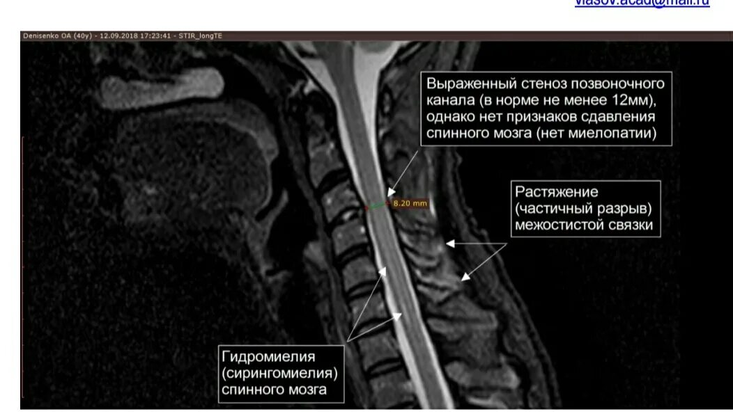 Киста в грудном отделе позвоночника. Киста в грудном отделе позвоночника