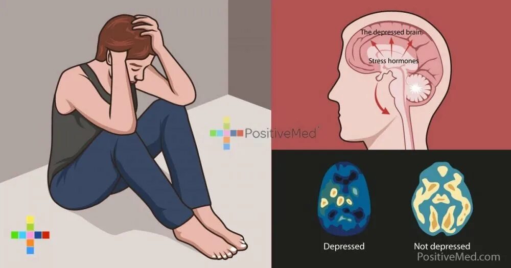 Депрессия мозг. Мозг при депрессии. Активность мозга в депрессии. Мозг депрессивного человека.