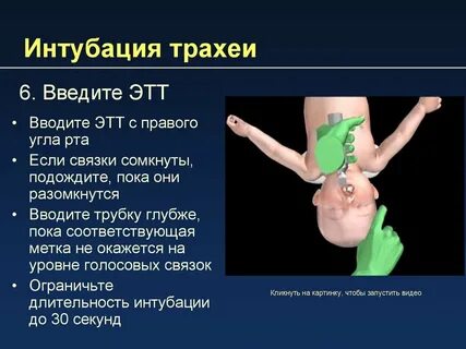 Интубация трахеи дети