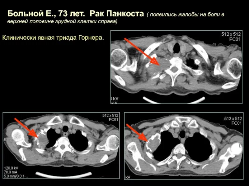 Что такое кт при онкологии