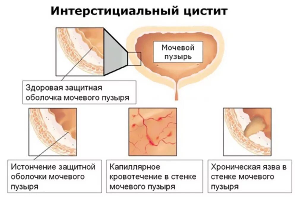 Цистит интерстициальный симптомы у женщин и лечение. Хронический интерстициальный цистит. Язва Гуннера интерстициальный цистит. Хронический гранулярный цистит. Интерстициальный цистит цистоскопия картина.