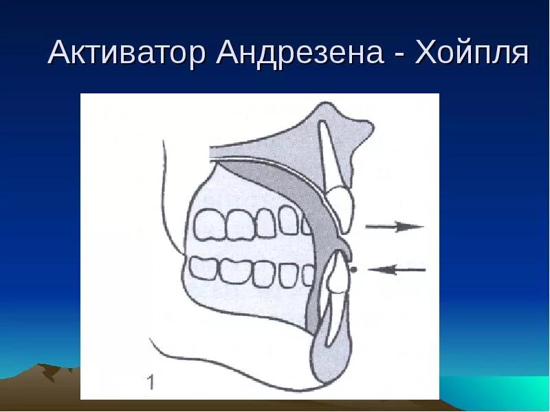 Активатор Андрезена-Хойпля. Моноблок Андрезена-Гойпля. Аппарат Андрезена-Гойпля. Конструктивные элементы аппарата Андрезена Хойпля. Активатор андрезена