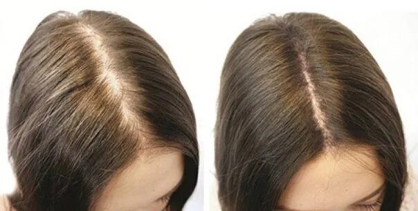 Стимулирование волос. Мезотерапия волос до и после. Рост волос на голове. Для роста волос. Рост волос до и после.