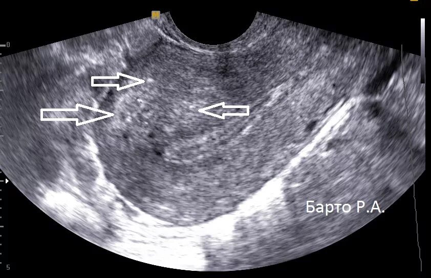 Эндометриоз аденомиоз матки. Эндометриоз матки УЗИ признаки. УЗИ картина эндометриоза. УЗИ картина аденомиоз матки.