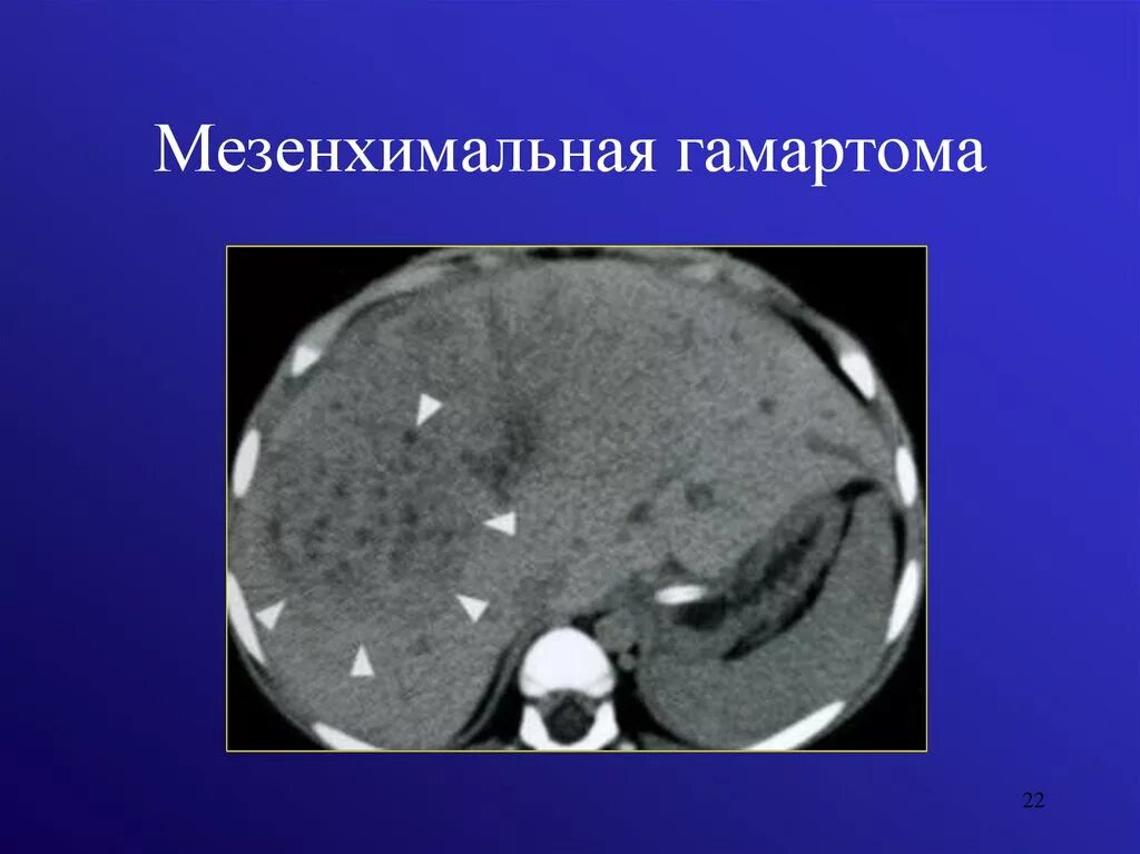 Гамартома печени. Билиарная гамартома печени кт. Мезенхимальная гамартома печени. Мезенхимальная гамартома печени клиника.