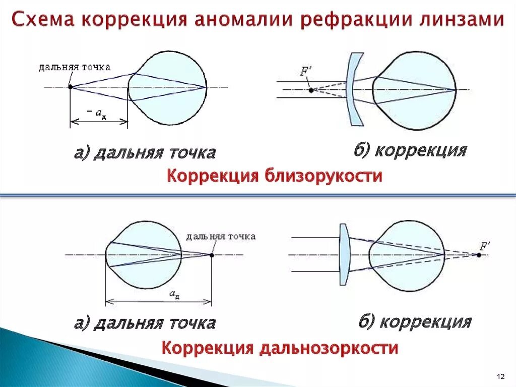 Коррекция зрения с помощью линз. Близорукость ход лучей в глазе. Ход лучей близорукость и дальнозоркость. Аномалии рефракции глаза астигматизм. Схема рефракции в близоруком глазу.