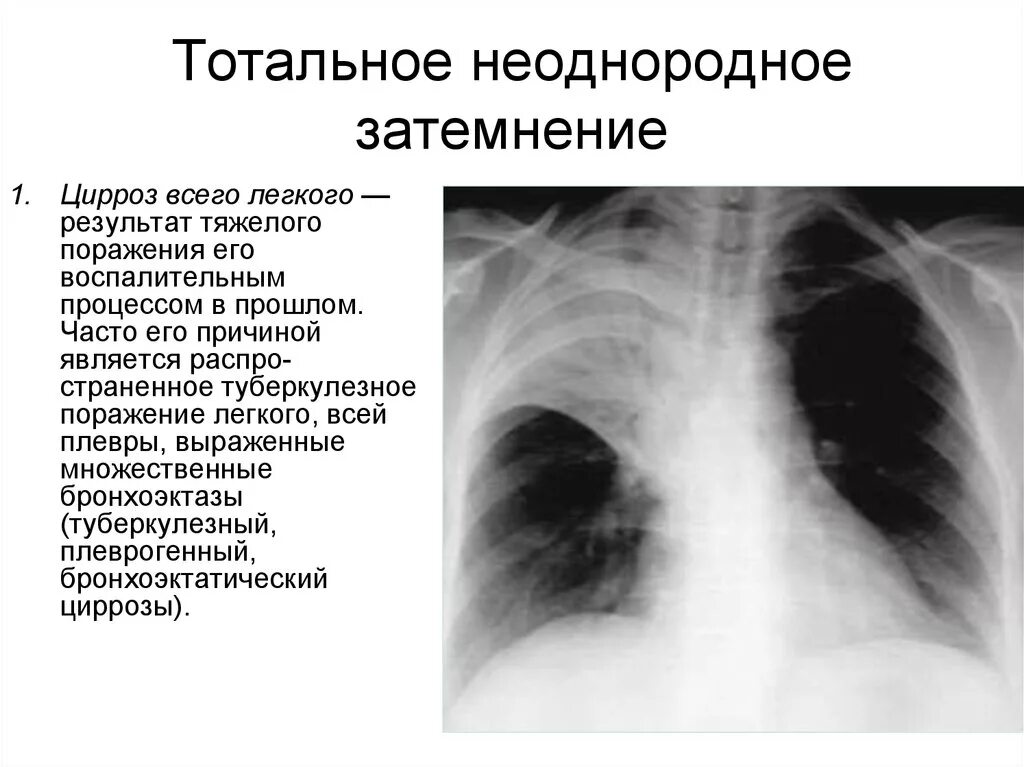 Затемнение в левом легком. Тотальная цирроз легкого рентген. Рентген тотальное затемнение легкого. Тотальное поражение легких.