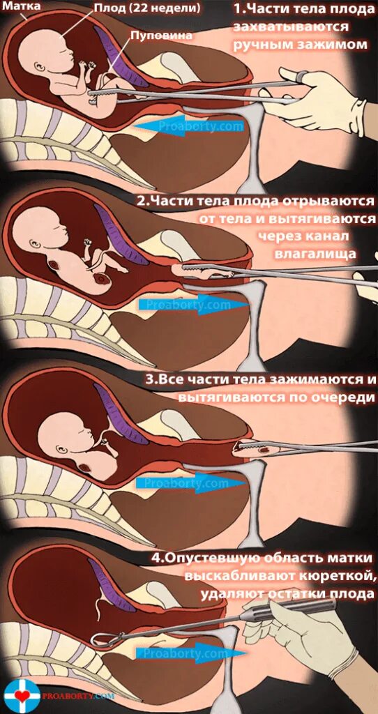 Кровотечение после выскабливания матки. Кюретажное выскабливание аборт. После хирургического аборта. Хирургическое вмешательство аборт. Хирургическое выскабливание полости матки.