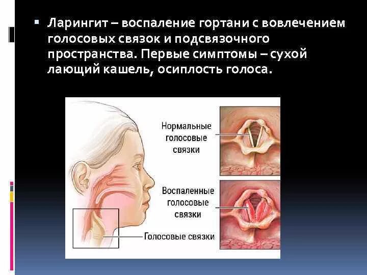 У ребенка кашель лающий осипший голос