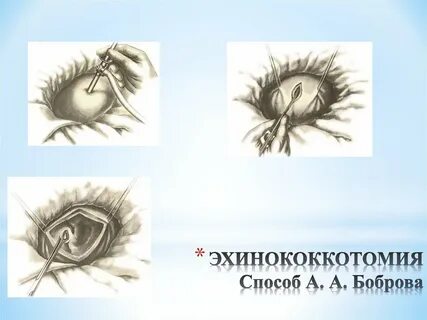 Марсупиализация бартолиновой железы